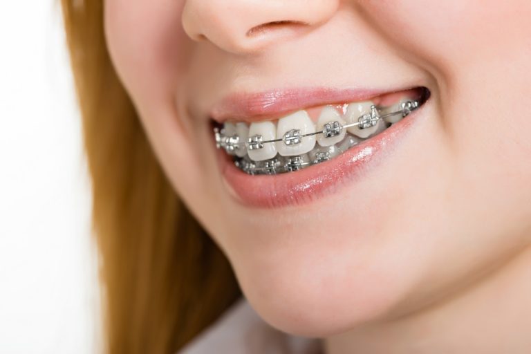 Traditional Metal Braces | Charlotte Orthodontist | Crown Point ...