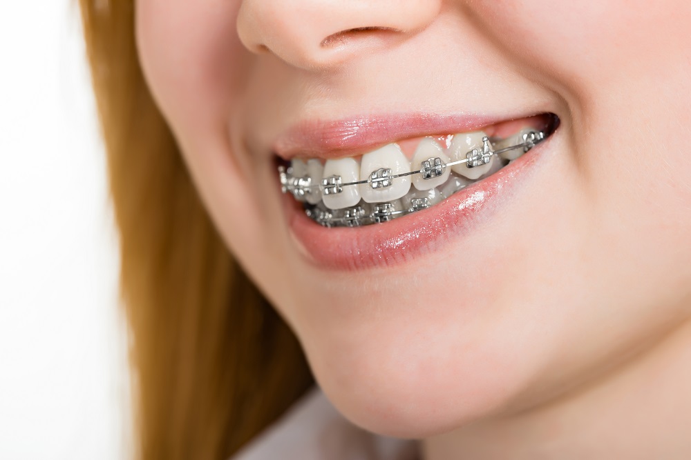traditional metal braces orthodontist charlotte nc